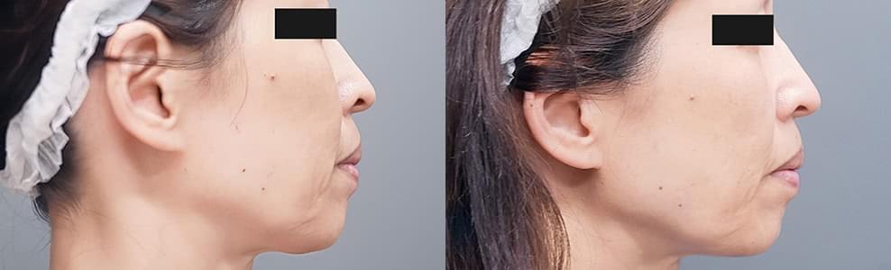 脂肪注入による他院修正「顔（頬コケ）」の症例写真（55歳）｜ザクリニック広島