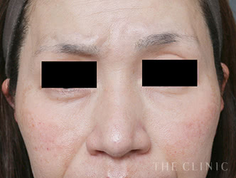 目の下脂肪注入の施術前の症例写真（52歳/女性）