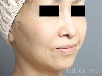 ほうれい線への脂肪注入施術後の症例写真（52歳/女性）
