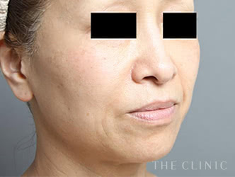 ほうれい線への脂肪注入施術前の症例写真（52歳/女性）
