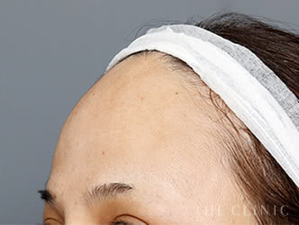 おでこへの脂肪注入施術後の症例写真（52歳/女性）
