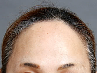 おでこへの脂肪注入施術前の症例写真（52歳/女性）