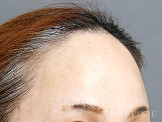 おでこへの脂肪注入施術前の症例写真（52歳/女性）