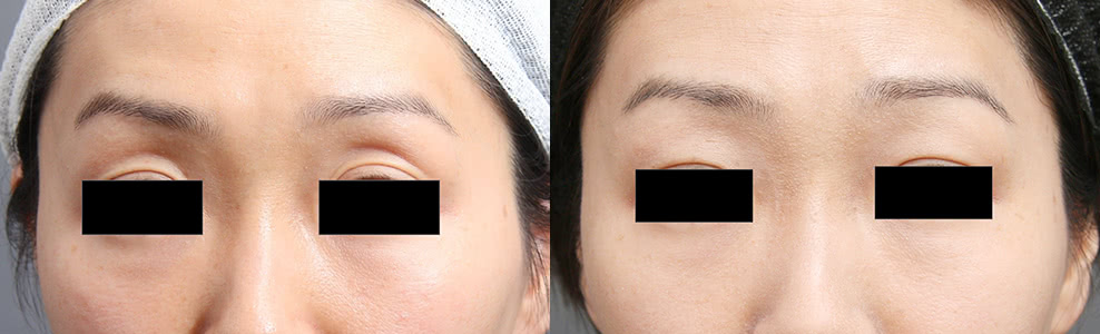 脂肪注入で目の上のくぼみを改善した症例写真（38歳/女性）｜ザクリニック広島院