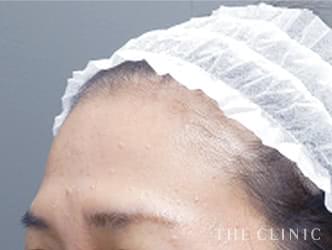 おでこ（額）のくぼみへの脂肪注入施術前の症例写真（38歳/女性）