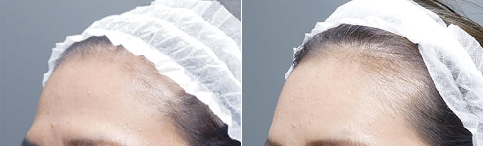 おでこ（額）脂肪注入の症例写真（50歳/女性）｜ザクリニック広島院