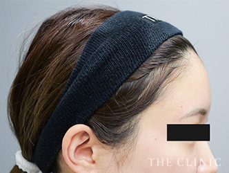 自然で丸いおでこをデザインした額の脂肪注入症例写真（31歳/女性）