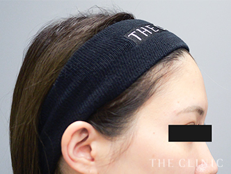 自然で丸いおでこをデザインした額の脂肪注入症例写真（31歳/女性）