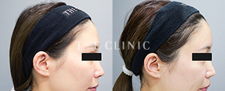 額への脂肪注入（31歳／女性）