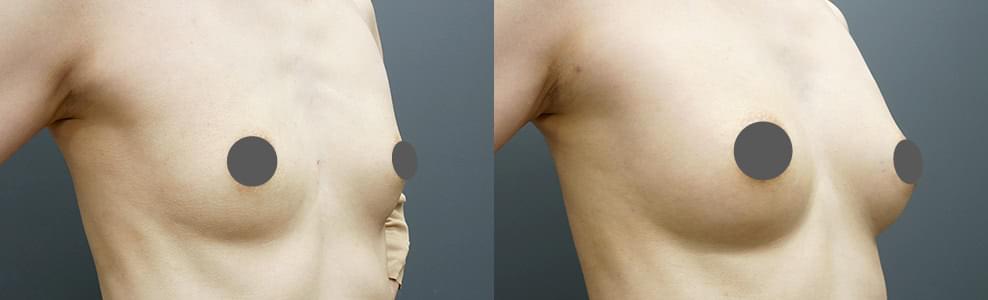エクソソーム豊胸の症例写真（49歳/女性）｜ザクリニック広島院