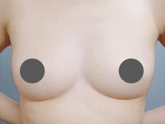 コンデンスリッチ豊胸の施術9ヵ月後の症例写真（29歳/女性）