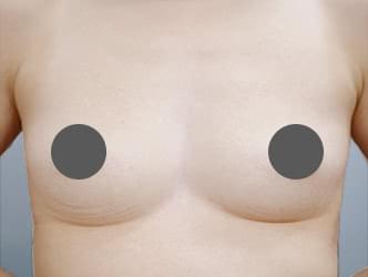 コンデンスリッチ豊胸の施術前の症例写真（29歳/女性）