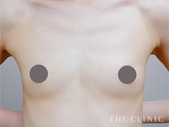 エクソソーム豊胸の施術前の症例写真（42歳/女性）