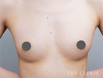 エクソソーム豊胸の施術後の症例写真（32歳/女性）
