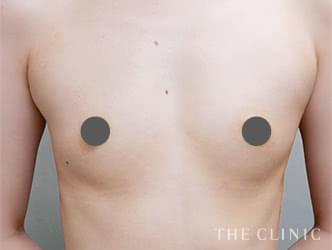 エクソソーム豊胸の施術前の症例写真（32歳/女性）