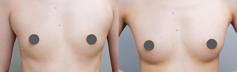 立体的なバストアップと谷間を叶えた脂肪注入豊胸の症例（32歳/女性）｜ザクリニック広島