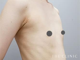 コンデンスビブラ豊胸の施術前の症例写真（21歳/女性）