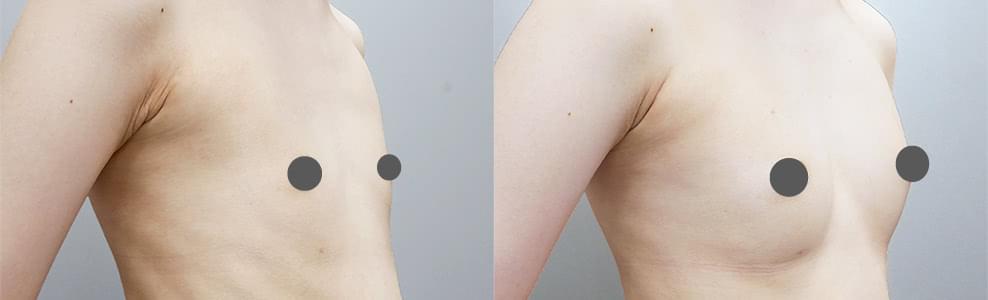 乳房拡張器ビブラを併用した脂肪注入豊胸の症例（21歳/女性）｜ザクリニック広島