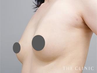 コンデンスリッチ豊胸の施術後の症例写真（49歳/女性）