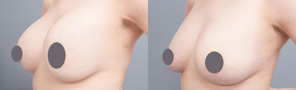 石灰化したシリコンバッグを脂肪注入で改善した女性の症例（41歳）｜ザクリニック広島