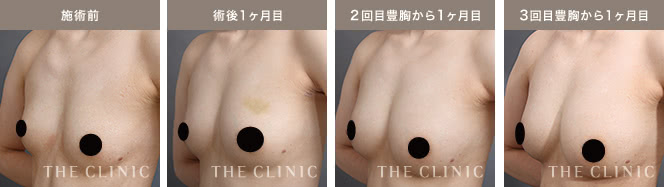 施術前 / 術後1ヶ月目 / 2回目豊胸から1ヶ月目 / 3回目豊胸から1ヶ月目