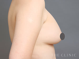シリコンバッグ抜去の施術前の症例写真（53歳/女性）