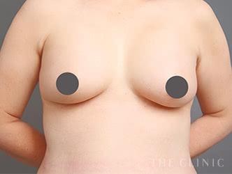 シリコンバッグ抜去の施術前の症例写真（53歳/女性）