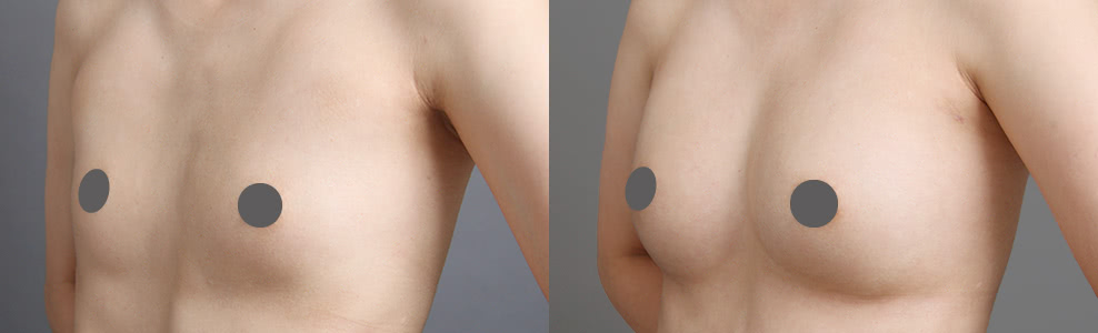 脂肪豊胸で漏斗胸による凹みを改善した症例写真（29歳/女性）｜ザクリニック広島院