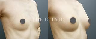 エクソソーム豊胸(49歳/女性)