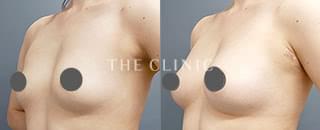 エクソソーム豊胸(33歳/女性)