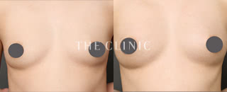 コンデンスリッチ豊胸(31歳/女性)