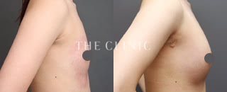 コンデンスリッチ豊胸(18歳/女性)