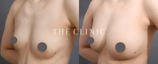 コンデンスリッチ豊胸(28歳/女性)