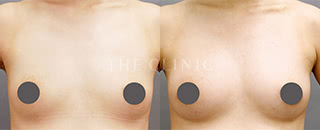 コンデンスリッチ豊胸(25歳/女性)