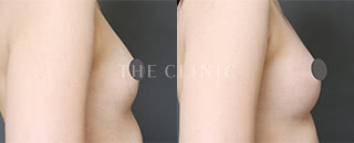 コンデンスリッチ豊胸(29歳/女性)