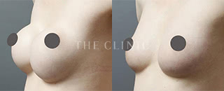 シリコンバッグ除去(29歳/女性)