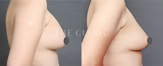 シリコンバッグ除去(53歳/女性)