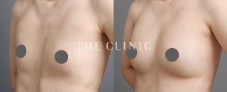 脂肪注入豊胸(29歳/女性)