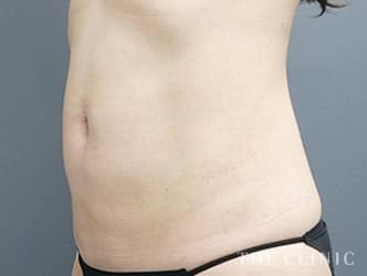 お腹の脂肪吸引の施術後の症例写真1（47歳/女性）