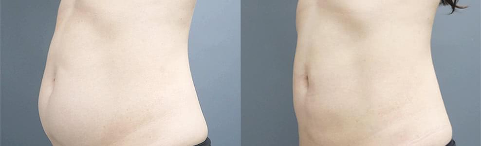 お腹の脂肪吸引の症例写真（41歳/女性）｜ザクリニック広島院