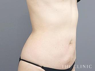 くびれの脂肪吸引の施術後の症例写真1（51歳/女性）