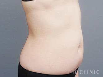 くびれの脂肪吸引の施術前の症例写真1（51歳/女性）