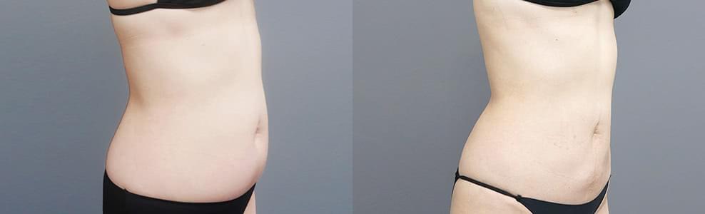 くびれ脂肪吸引の症例写真（51歳/女性）｜ザクリニック広島院