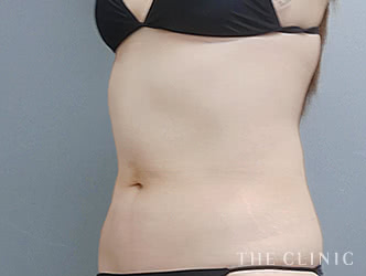 くびれの脂肪吸引の施術前の症例写真1（51歳/女性）