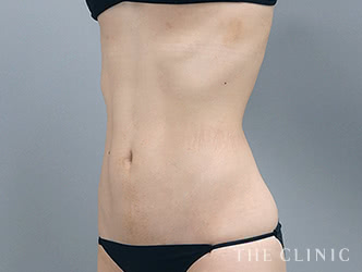 くびれの脂肪吸引の施術後の症例写真1（51歳/女性）