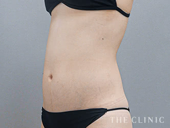 くびれの脂肪吸引の施術前の症例写真1（51歳/女性）