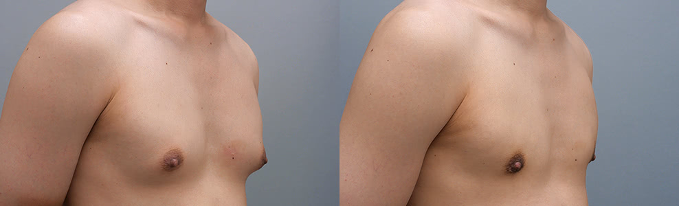 女性化乳房治療(男性の胸の膨らみ改善)の症例写真（23歳/男性）｜ザクリニック広島院