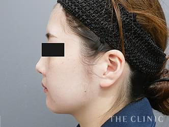 ベイザー脂肪吸引の施術前後の症例写真1（27歳/女性）