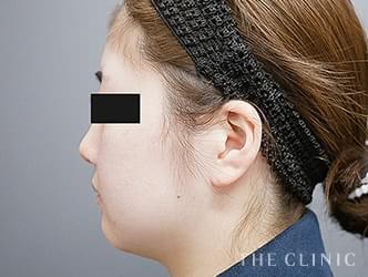 ベイザー脂肪吸引の施術前の症例写真1（27歳/女性）