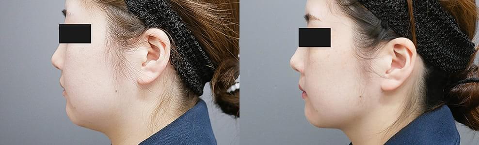 脂肪吸引「顔（ホホ・アゴ下）」の症例写真（27歳）｜ザクリニック広島